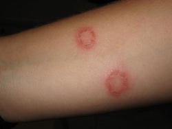 teigne enfant rond contamination zoonose