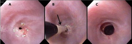 sang selles chat endoscopie