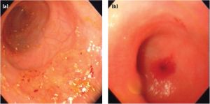 sang-selles-chien-endoscopie sang selles chien endoscopie