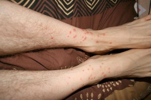 aoutats homme piqures