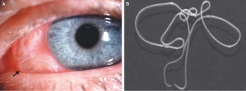 zoonose-dirofilaria-repens-oeil-humain vers coeur chien chat dirofilaria immitis repens zoonose